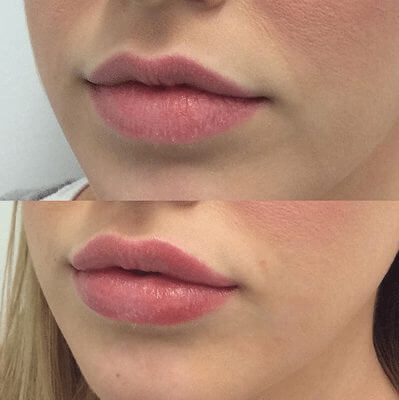 Lip Filler - The Cosmetic Clinic