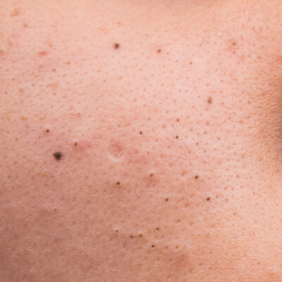 Blackheads - The Cosmetic Clinic