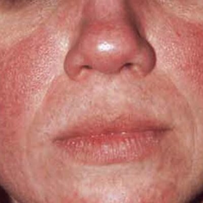 clinic skin treatment Cosmetic Redness The  Clinic Rosacea  /