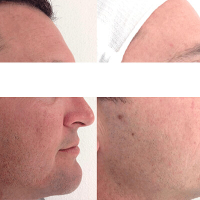 Micro-Needling - The Cosmetic Clinic